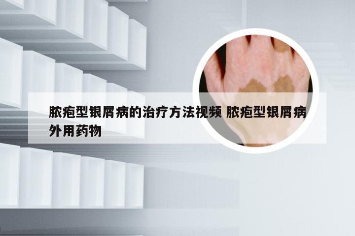 脓疱型银屑病的治疗方法视频 脓疱型银屑病外用药物