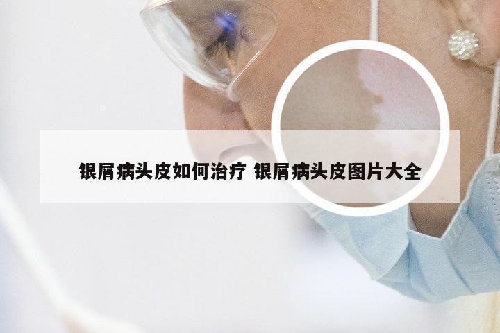 银屑病头皮如何治疗 银屑病头皮图片大全
