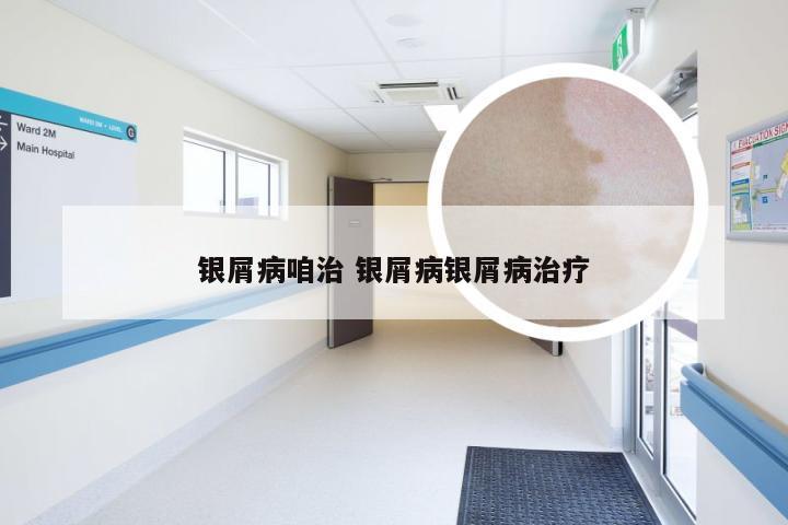 银屑病咱治 银屑病银屑病治疗
