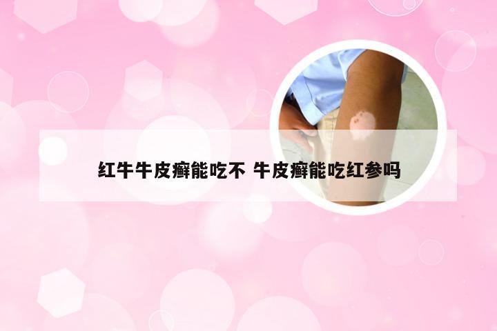 红牛牛皮癣能吃不 牛皮癣能吃红参吗