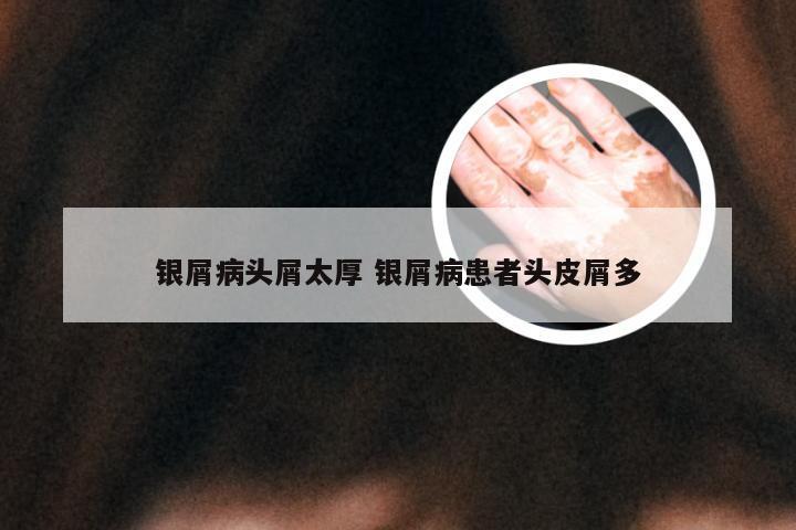 银屑病头屑太厚 银屑病患者头皮屑多