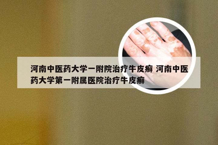 河南中医药大学一附院治疗牛皮癣 河南中医药大学第一附属医院治疗牛皮癣