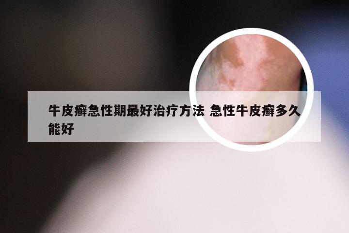 牛皮癣急性期最好治疗方法 急性牛皮癣多久能好