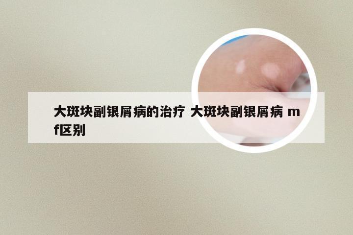 大斑块副银屑病的治疗 大斑块副银屑病 mf区别