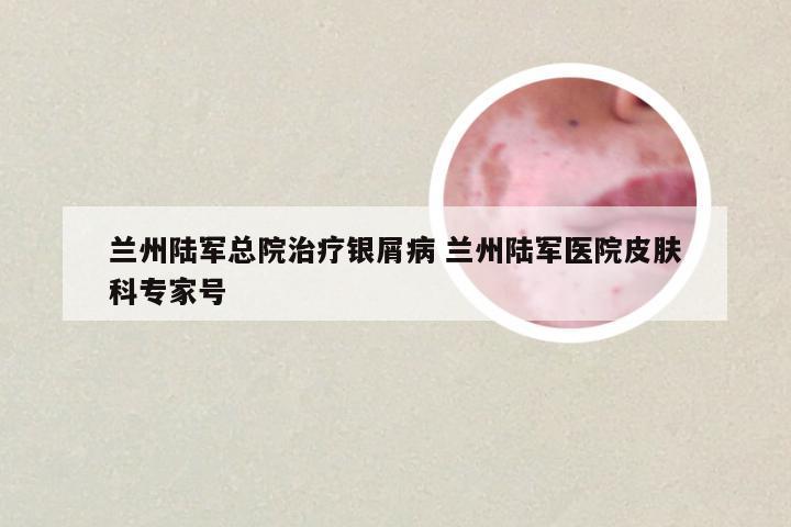 兰州陆军总院治疗银屑病 兰州陆军医院皮肤科专家号