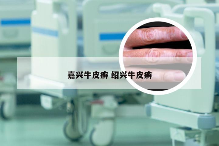 嘉兴牛皮癣 绍兴牛皮癣