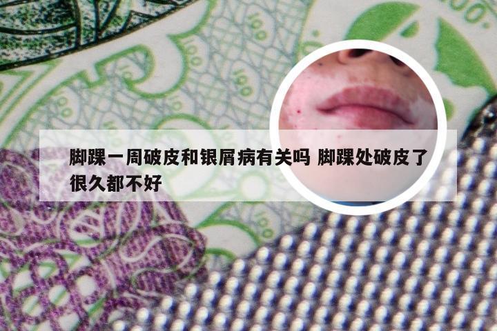 脚踝一周破皮和银屑病有关吗 脚踝处破皮了很久都不好