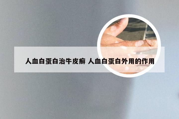 人血白蛋白治牛皮癣 人血白蛋白外用的作用