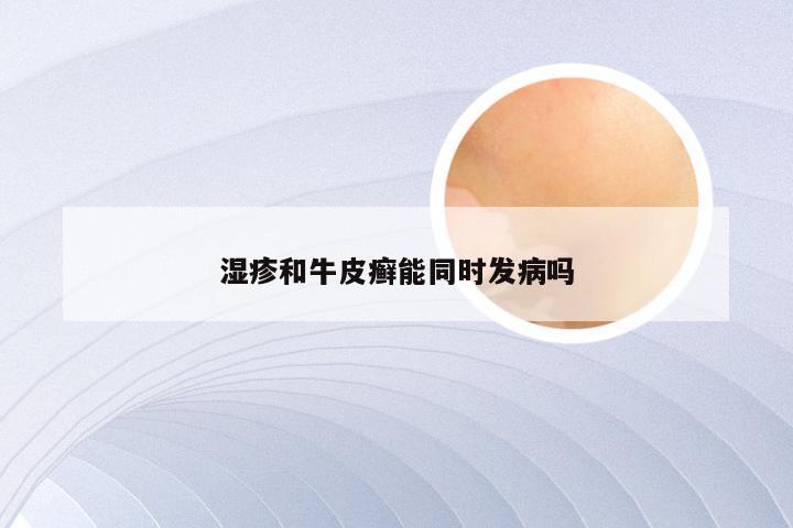 湿疹和牛皮癣能同时发病吗