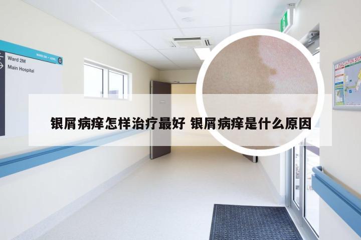 银屑病痒怎样治疗最好 银屑病痒是什么原因