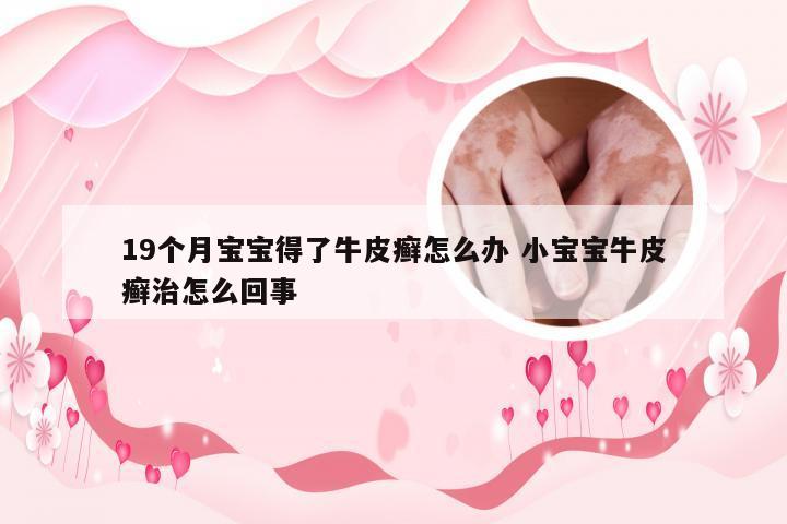 19个月宝宝得了牛皮癣怎么办 小宝宝牛皮癣治怎么回事
