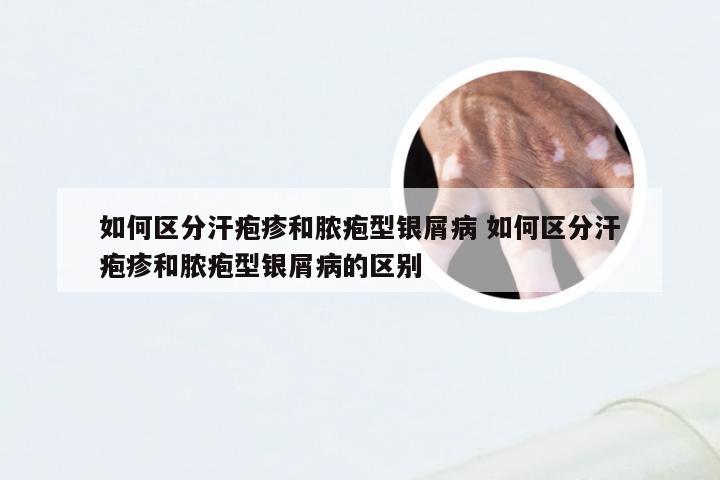 如何区分汗疱疹和脓疱型银屑病 如何区分汗疱疹和脓疱型银屑病的区别