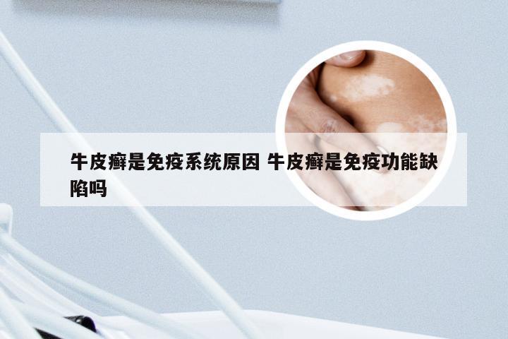 牛皮癣是免疫系统原因 牛皮癣是免疫功能缺陷吗