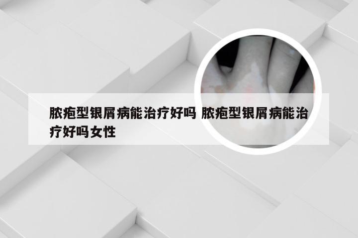 脓疱型银屑病能治疗好吗 脓疱型银屑病能治疗好吗女性