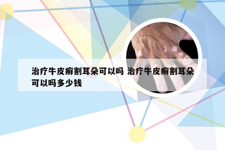 治疗牛皮癣割耳朵可以吗 治疗牛皮癣割耳朵可以吗多少钱