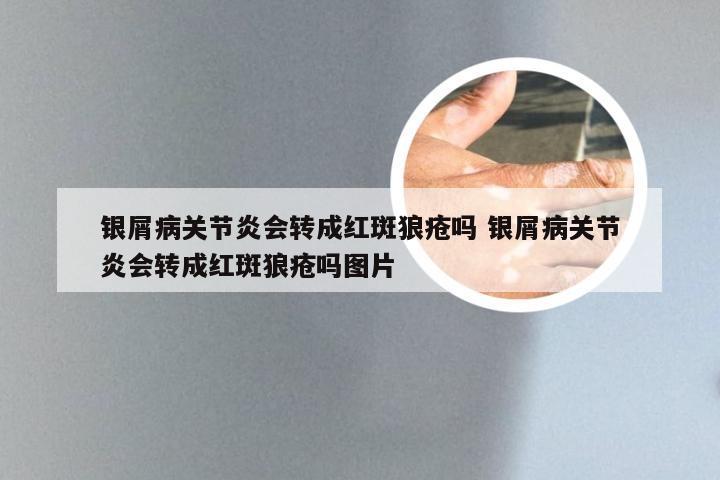 银屑病关节炎会转成红斑狼疮吗 银屑病关节炎会转成红斑狼疮吗图片