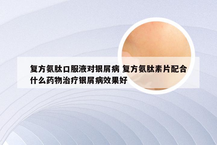 复方氨肽口服液对银屑病 复方氨肽素片配合什么药物治疗银屑病效果好
