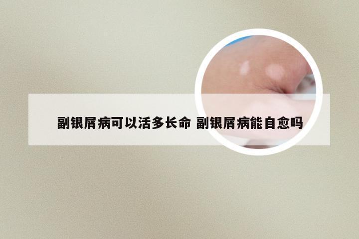 副银屑病可以活多长命 副银屑病能自愈吗