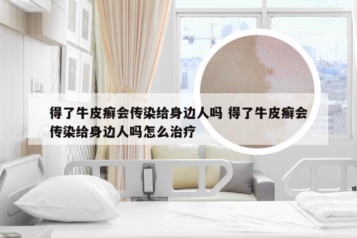 得了牛皮癣会传染给身边人吗 得了牛皮癣会传染给身边人吗怎么治疗