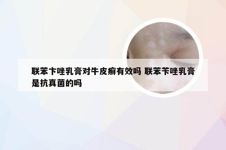 联苯卞唑乳膏对牛皮癣有效吗 联苯苄唑乳膏是抗真菌的吗