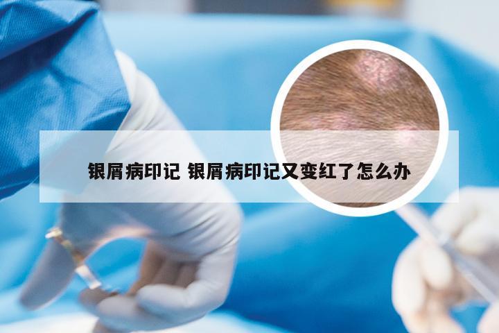 银屑病印记 银屑病印记又变红了怎么办