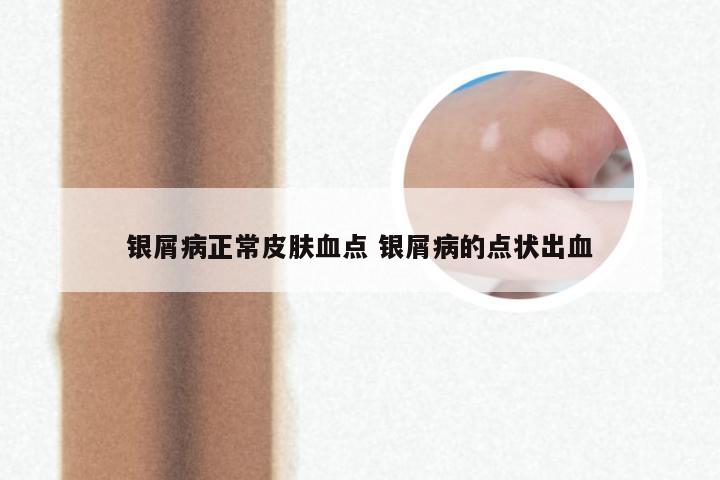 银屑病正常皮肤血点 银屑病的点状出血