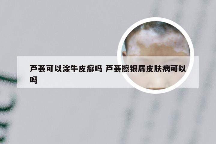芦荟可以涂牛皮癣吗 芦荟擦银屑皮肤病可以吗