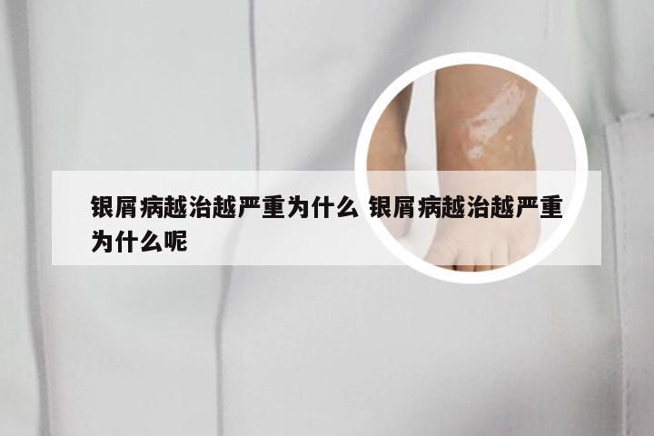 银屑病越治越严重为什么 银屑病越治越严重为什么呢