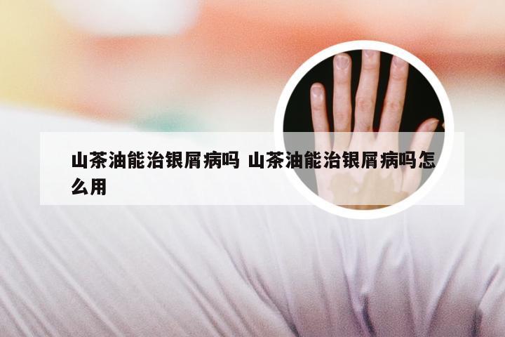 山茶油能治银屑病吗 山茶油能治银屑病吗怎么用