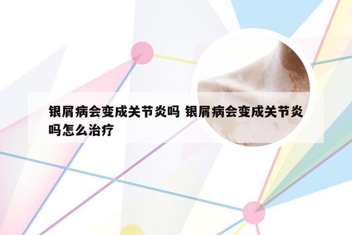 银屑病会变成关节炎吗 银屑病会变成关节炎吗怎么治疗