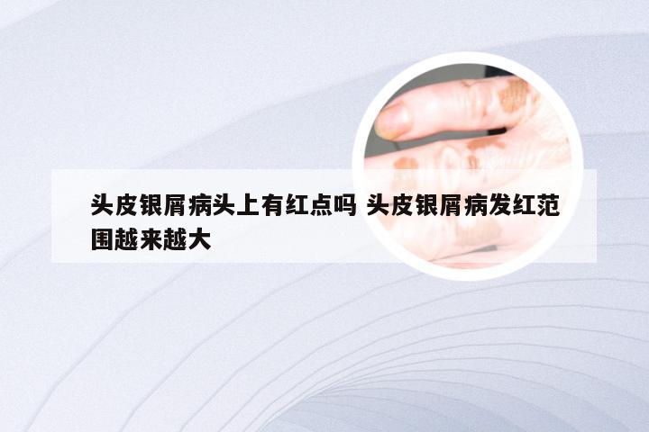 头皮银屑病头上有红点吗 头皮银屑病发红范围越来越大