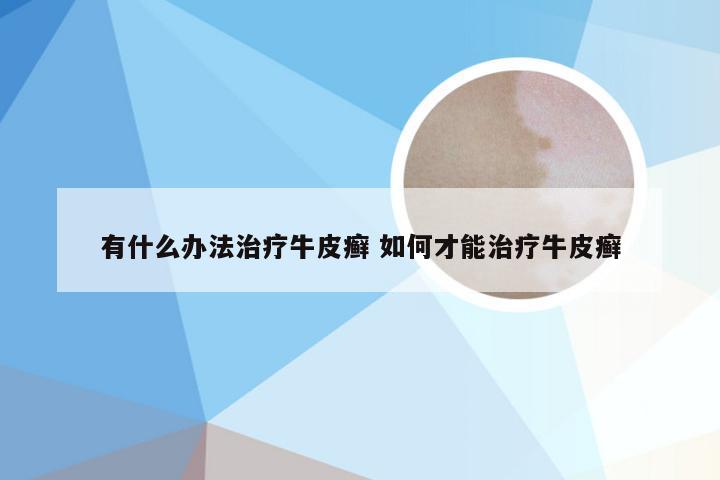 有什么办法治疗牛皮癣 如何才能治疗牛皮癣