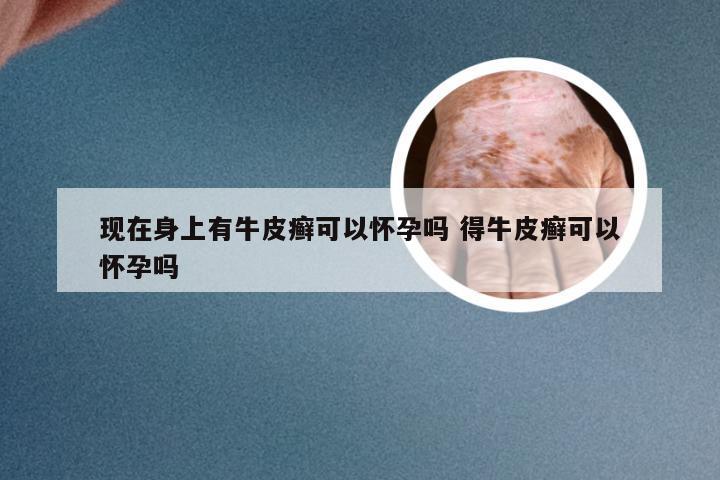 现在身上有牛皮癣可以怀孕吗 得牛皮癣可以怀孕吗