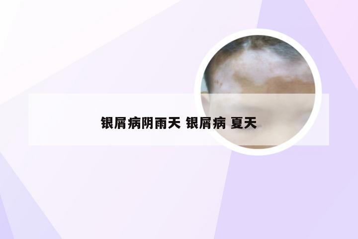 银屑病阴雨天 银屑病 夏天
