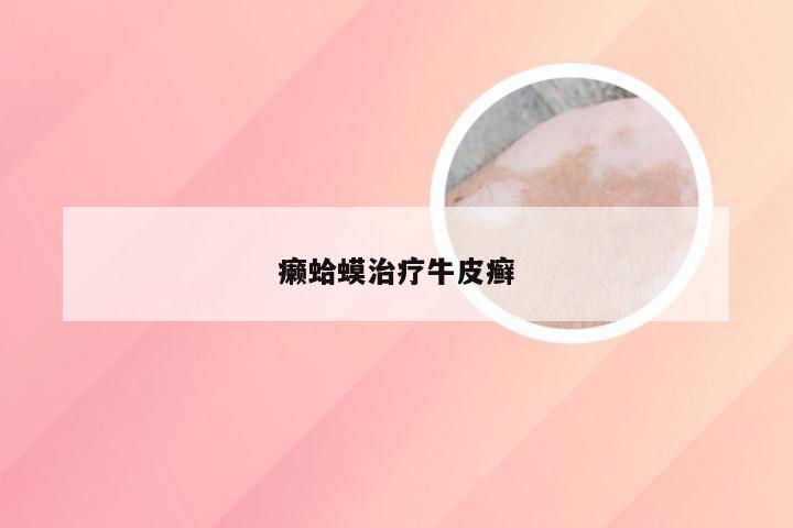 癞蛤蟆治疗牛皮癣