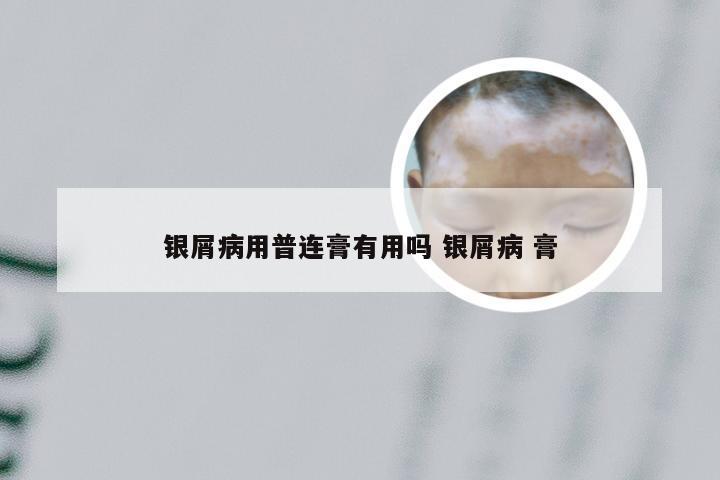 银屑病用普连膏有用吗 银屑病 膏