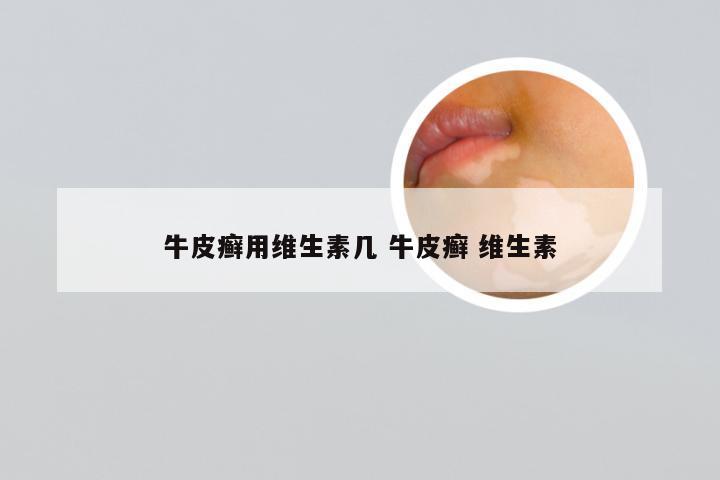 牛皮癣用维生素几 牛皮癣 维生素
