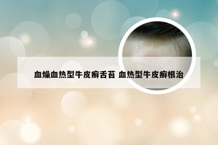 血燥血热型牛皮癣舌苔 血热型牛皮癣根治