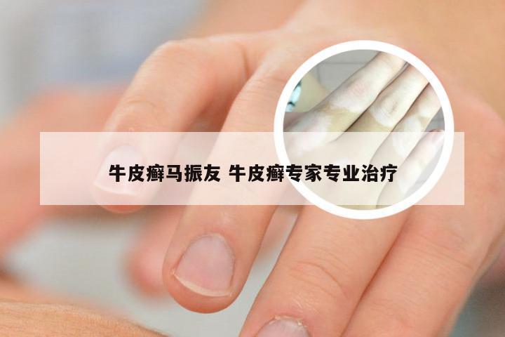 牛皮癣马振友 牛皮癣专家专业治疗
