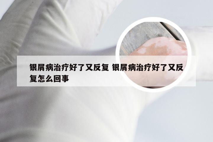 银屑病治疗好了又反复 银屑病治疗好了又反复怎么回事