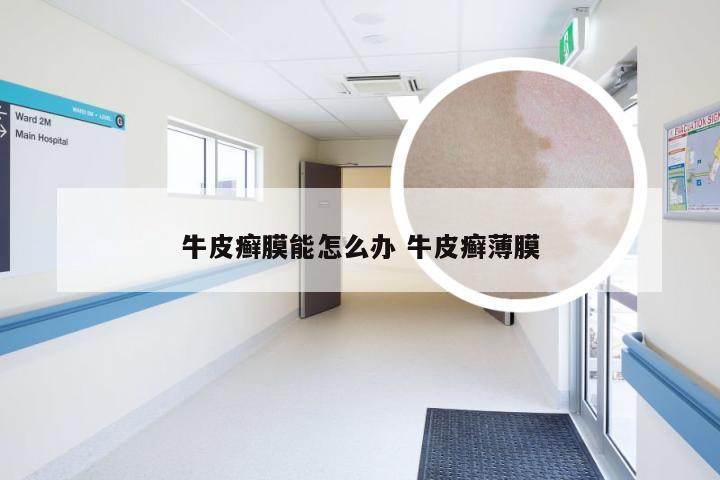 牛皮癣膜能怎么办 牛皮癣薄膜