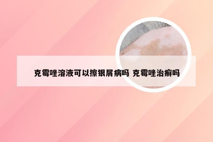 克霉唑溶液可以擦银屑病吗 克霉唑治癣吗