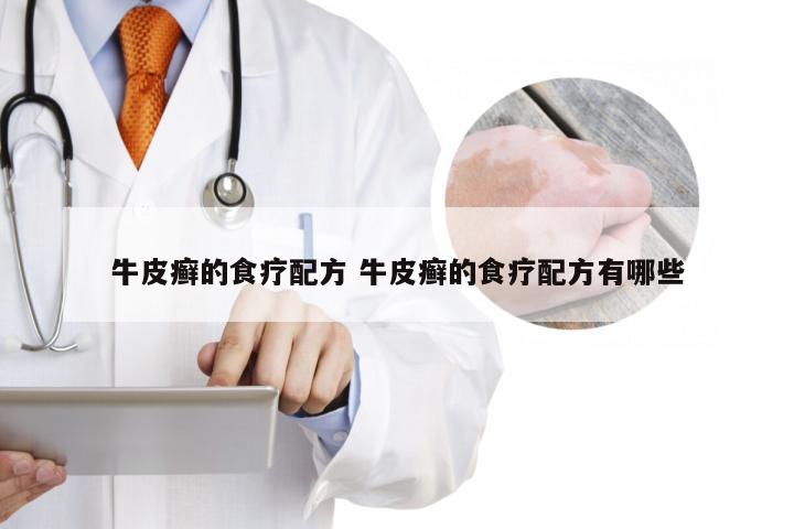 牛皮癣的食疗配方 牛皮癣的食疗配方有哪些