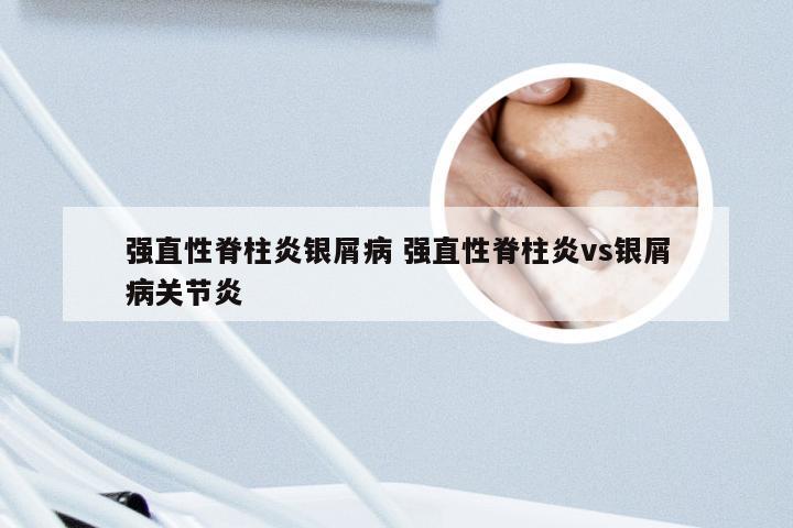 强直性脊柱炎银屑病 强直性脊柱炎vs银屑病关节炎