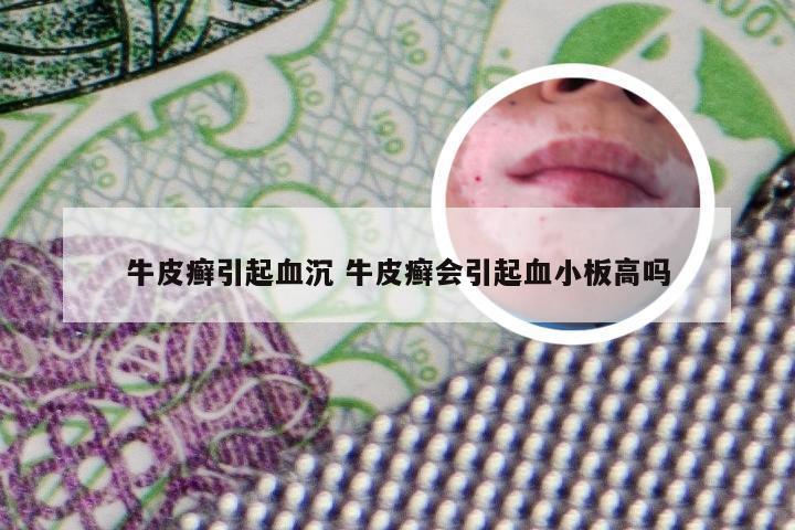 牛皮癣引起血沉 牛皮癣会引起血小板高吗