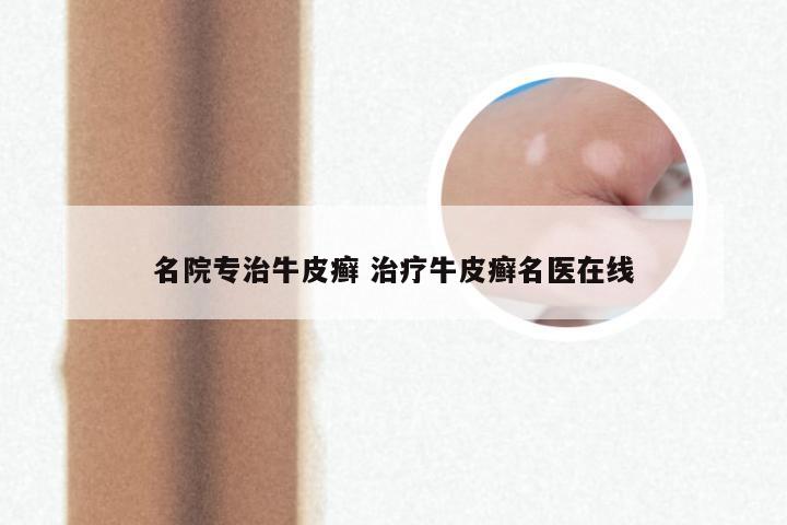 名院专治牛皮癣 治疗牛皮癣名医在线