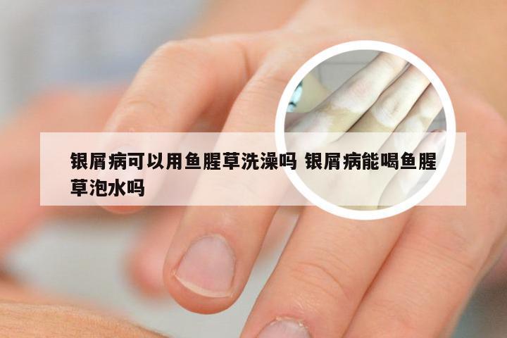 银屑病可以用鱼腥草洗澡吗 银屑病能喝鱼腥草泡水吗