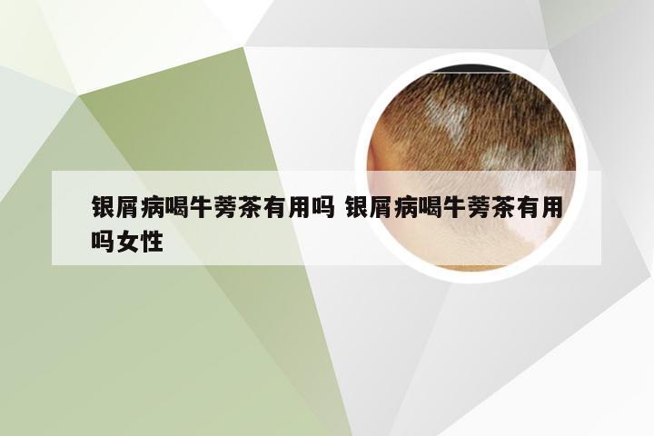 银屑病喝牛蒡茶有用吗 银屑病喝牛蒡茶有用吗女性