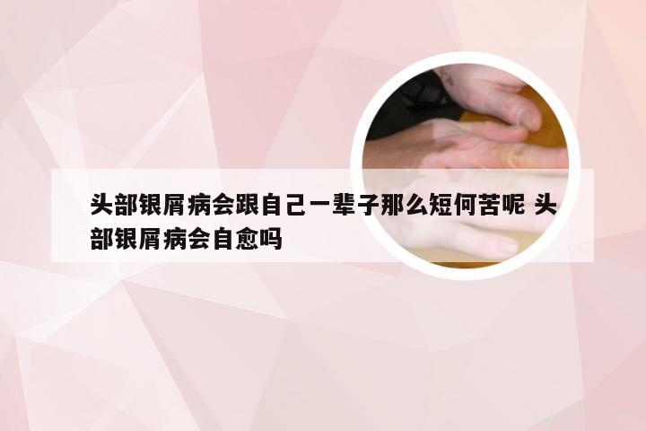 头部银屑病会跟自己一辈子那么短何苦呢 头部银屑病会自愈吗