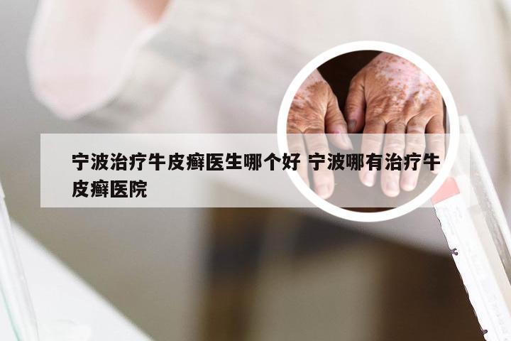 宁波治疗牛皮癣医生哪个好 宁波哪有治疗牛皮癣医院